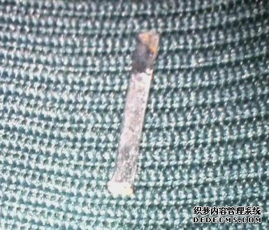 患者颅内的金属。